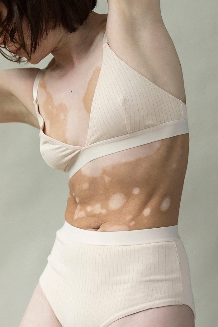 vitiligo snapped