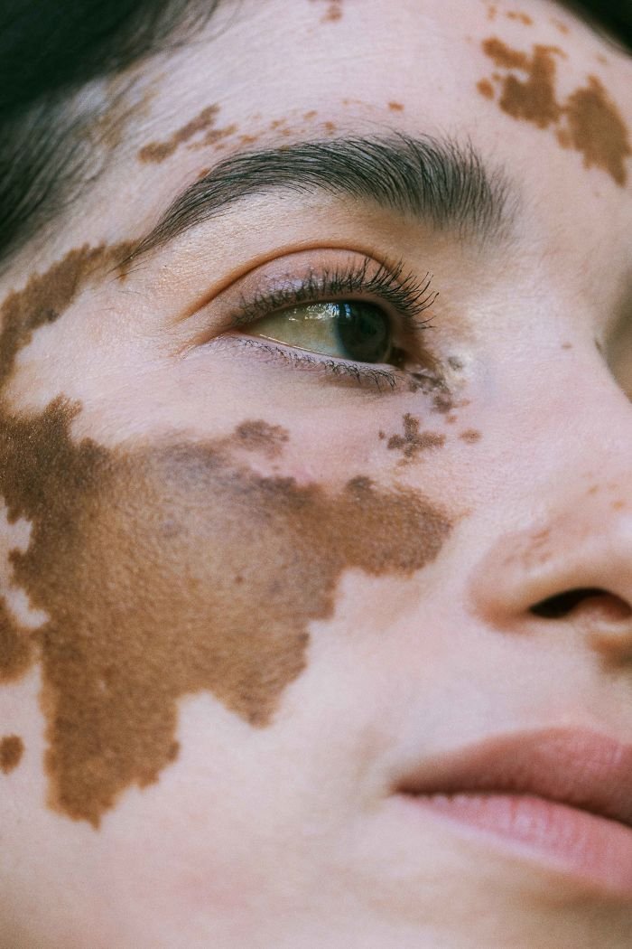 35 Gorgeous Women With Vitiligo Snapped By A Photographer Who Has The